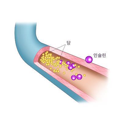 당뇨병