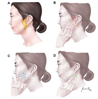 이하선암 자가검진법.