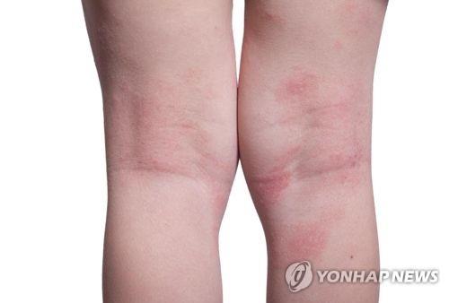 아토피성 피부염