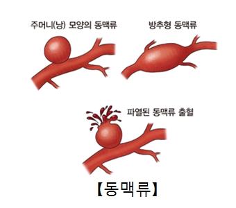 동맥류