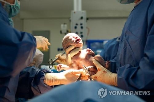 제왕절개
